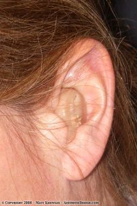 Hearing Aid